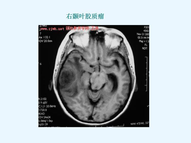 常见脑肿瘤的影像诊断——胶质瘤【星型细胞瘤】