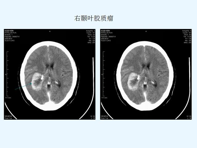 常见脑肿瘤的影像诊断——胶质瘤【胶质母细胞瘤】