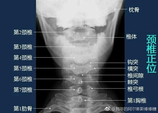 颈椎侧位片解剖图片